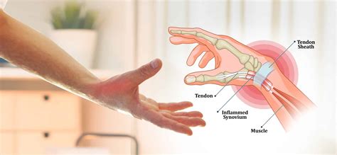 De Quervain S Tenosynovitis Thumb Pain Painful Wrist