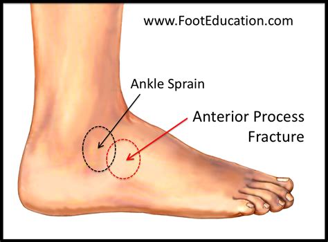 Anterior Process Fracture Of The Calcaneus FootEducation