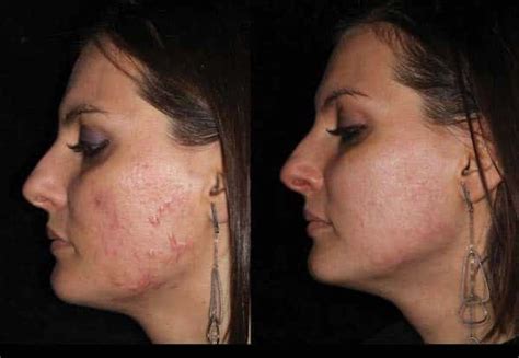 Best Acne Scar Treatment Nyc Top Dermatology Experts
