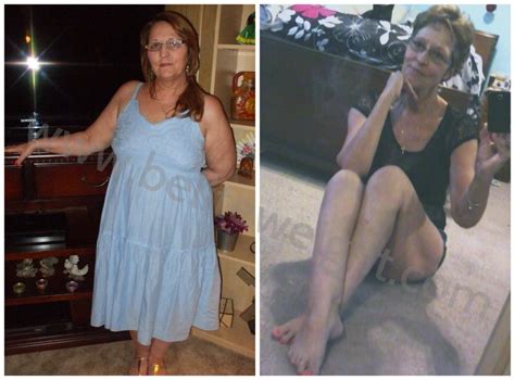 Gastric bypass insurance coverage may only be possible in cases where a patient is morbidly obese and has complicating health problems, such as a heart condition or severely damaged knees. Pin on Weight Loss Success Stories - Before And After Photos & Videos