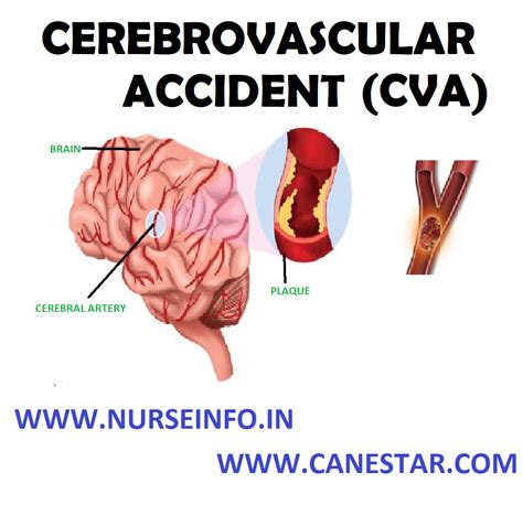 Cerebrovascular Accident Stroke Nurse Info