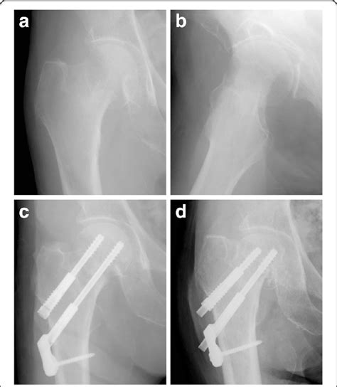 Radiographs Showing A Case Of Non Union Of Femoral Neck Fracture After