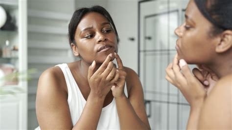 Adult Acne What To Know About The Frustrating Skin Condition