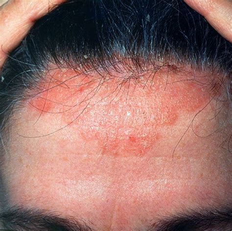Scabies On The Scalp Pictures Photos