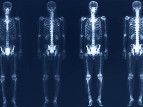 Bone Scan What Does It Show
