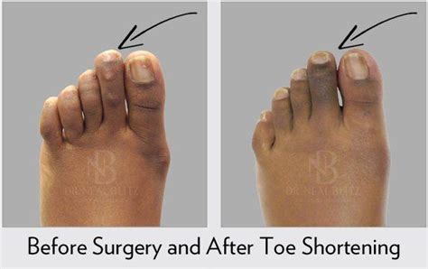 Toe Shortening Before And After Hammer Toe Surgery Hammer Toe Surgery