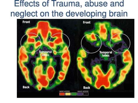 Brain Images Neglect Trauma Development Impact Healing