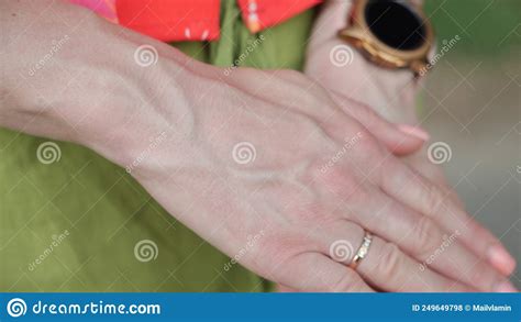 Bulging Veins On Women S Arms Stock Photo Image Of Care Arthritis