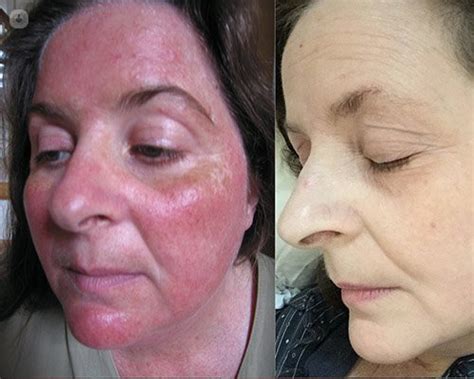 Facial Flushing And Rosacea Whats The Difference
