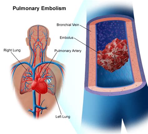 Pulmonary Embolism Medicalopedia
