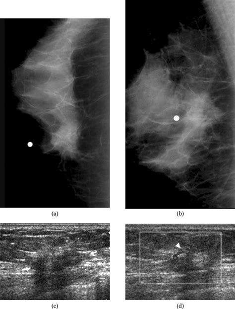 Mammogram Of A 64 Year Old Woman With A Palpable Lump In The Left