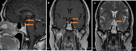 Pituitary Infundibular Epidermoid Cyst A Rare Cause Of Hypopituitarism