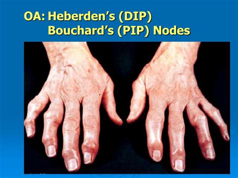 Heberden S Nodes Treatment
