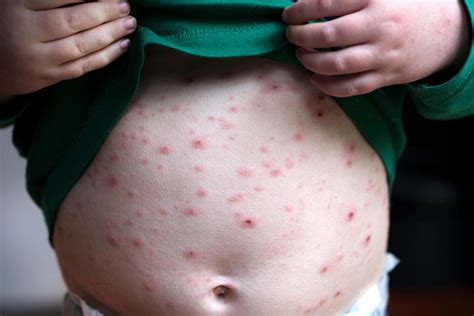 Where Does Chickenpox Start Advisers Tell Nhs To Give Toddlers