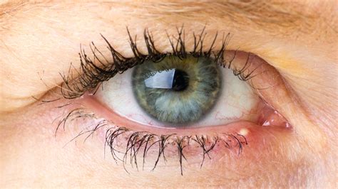 Heres Whats Really Causing Your Stye