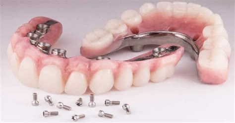 Full Mouth Dental Implants In Ponte Vedra Rated 5 Stars
