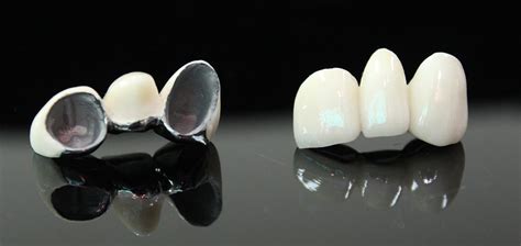 Pfm Porcelain Fused To Metal Gnathodontics