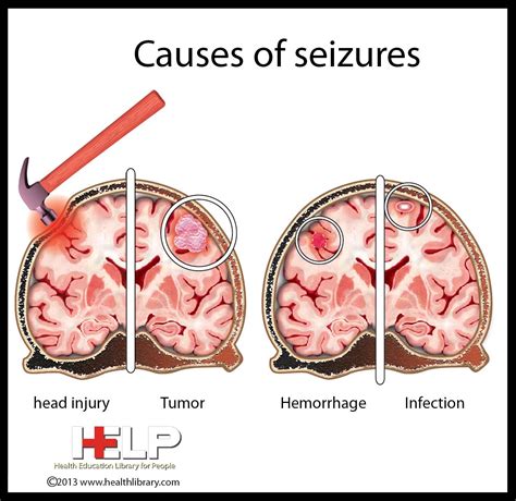 Causes Of Seizures Go See This Pin Board For Health Infographics
