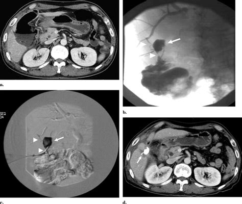 Percutaneous Embolization Of Persistent Biliary And Enteric Fistulas With Histoacryl Journal