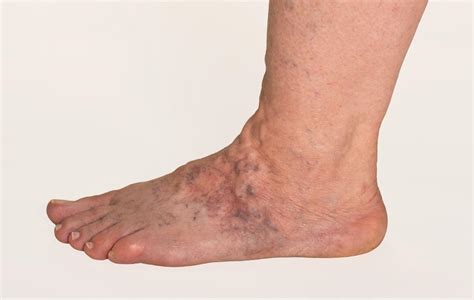 Why Are The Veins In My Feet Bulging Usa Vein Clinics