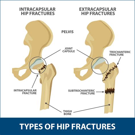 Hip Bone Fracture