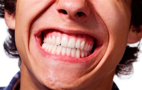 Teeth Grinding Causes Symptoms And Treatments
