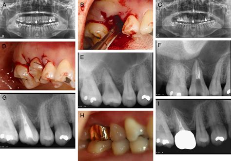 Autotransplantation Of Teeth With Complete Root Formation A Case