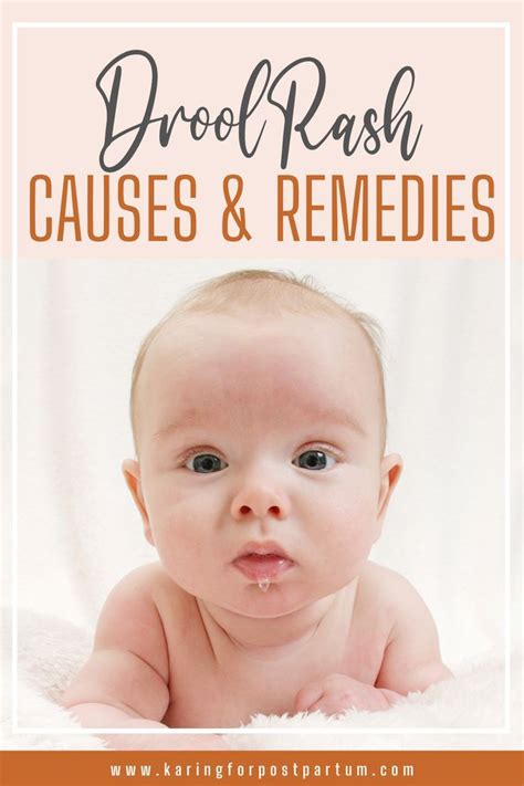 How To Prevent And Treat Drool Rash In Babies Karrie Locher In 2022