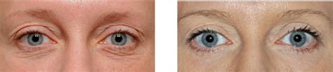 The Pinch And Peel Lower Blepharoplasty Explore Plastic Surgery