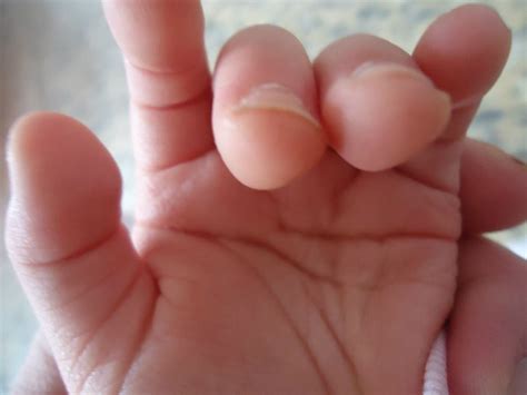 They are often slow to turn over. Hands & palmar creases (in children with Down's syndrome ...