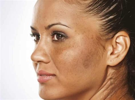 Pigmentation Treatment In Indian Skin By Top Dermatologist