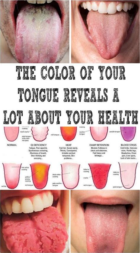 The Color Of Your Tongue Reveals A Lot About Your Health Tongue