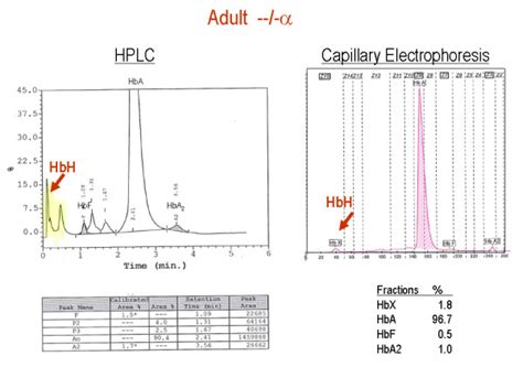 Hplc And Capillary Hb Electrophoresis Patterns Of An Adult With Hbh