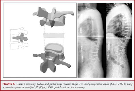 Figure 4 From The Comprehensive Anatomical Spinal Osteotomy