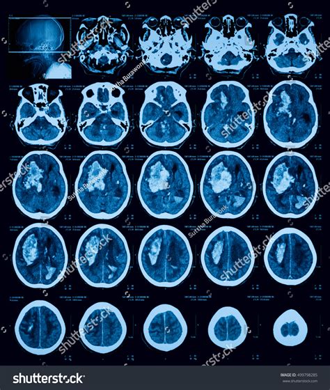 Computed Tomography Ct Cat Scan Brain Stock Photo 499798285 Shutterstock