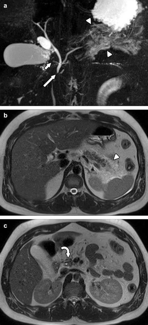 Pancreatitis In Pancreas Divisum A Mrcp Image And Axial T2 Weighted