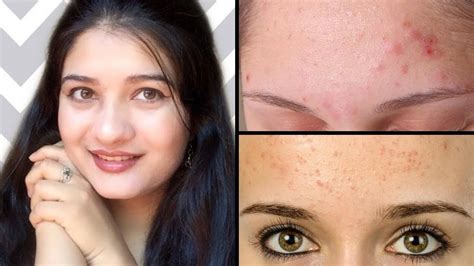 Clear Tiny Forehead Bumps How To Get Rid Of Small Pimples Head Bumps