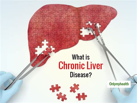 Chronic Liver Disease Signs And Symptoms Gastroenterologist Tips To