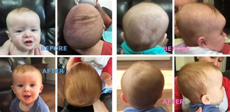 How To Fix My Babys Flat Head And Twisted Neck For All Parents