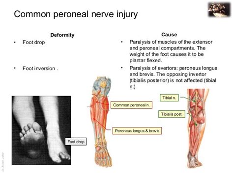 Deep Peroneal Nerve Injury