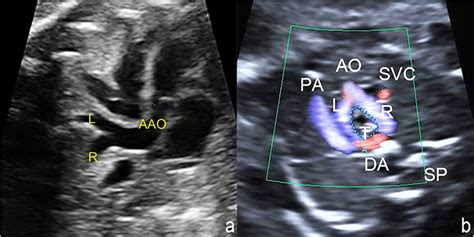 Bifurcation Of The Ascending Aorta And A Complete Vascular Ring Of The