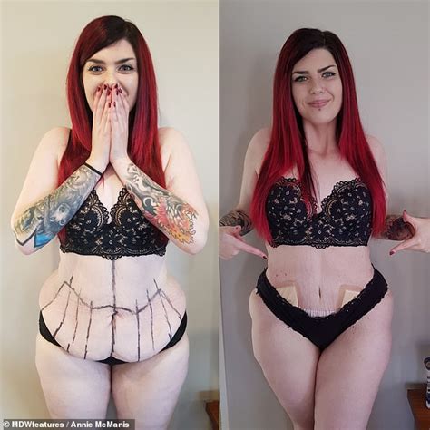 Incredible Transformation Of Woman Who Had Excess Skin Removed