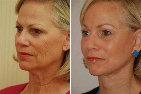 Rediscover a new you with the help of one of new york's most trusted plastic surgeons. Endoscopic Brow Lift, Forehead Lift for Women in New York ...