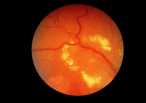 Fundus Camera Image Of A Diabetic Retina Photograph By Science Photo