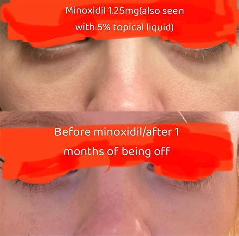 Topical And Oral Minoxidil Causing Dark Circlesbags What Are My