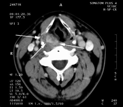 What Is A Ct Scan With Contrast Of The Neck Images And Photos Finder