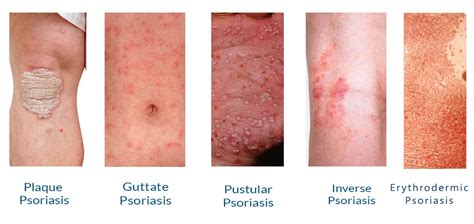 Psoriasis Symptoms And Treatment In India