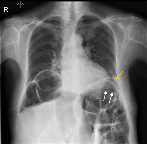 Chilaiditis Syndrome With Perforation Radiology At St Vincents