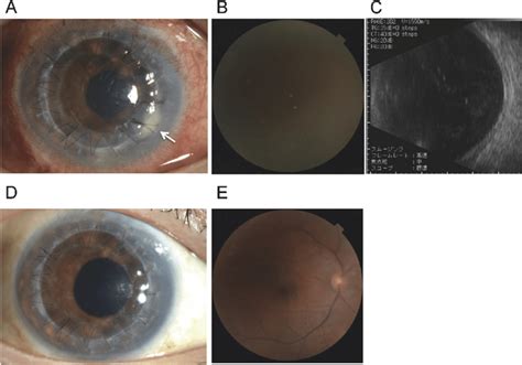 Slit Lamp Examination Retinal Fundus And B Scan Ultrasound Images