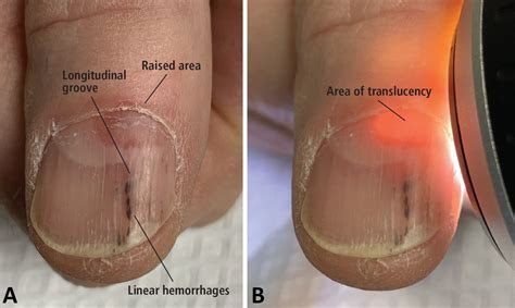 Shedding Light On Subungual Digital Mucous Cysts Cleveland Clinic